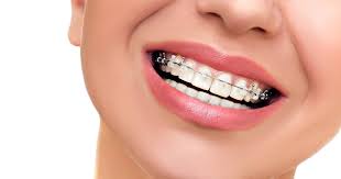invisible teeth aligners, invisible braces, dental braces near me, orthodontist los angeles, best orthodontist